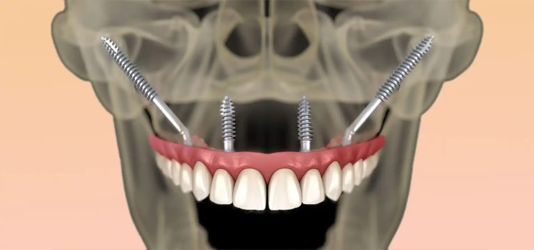 Zigomatik İmplant Yöntemi Kimler İçin Uygundur?