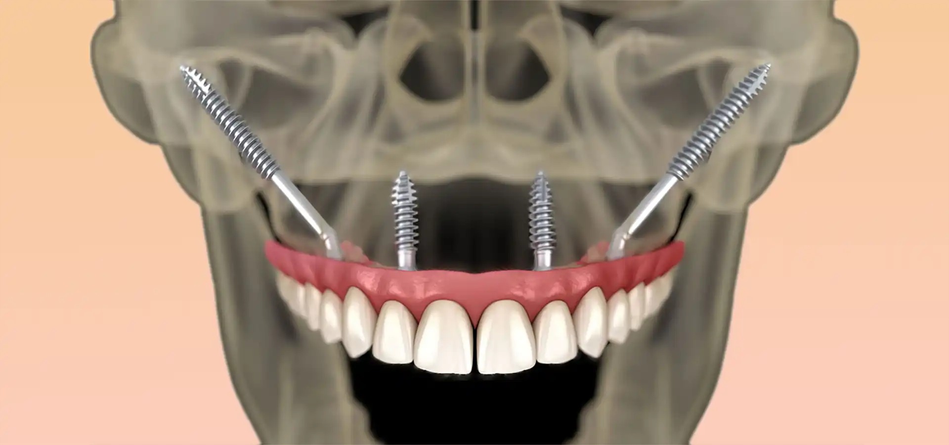 Zigomatik İmplant Yöntemi Kimler İçin Uygundur?